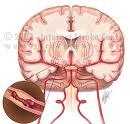 Stroke-rl ingyenes elads Nyregyhzn